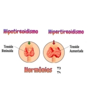 Hipotireoidismo e Hipertireoidismo