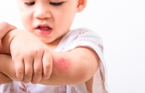 Alergia ao Leite em Bebês- O que Fazer?